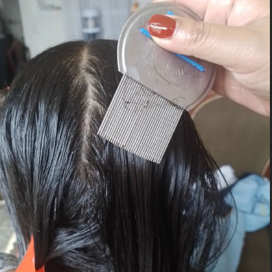 💆‍♂️ Cabello limpio: Por qué salen los piojos, a qué edad atacan más y cómo eliminarlos para siempre
